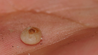 Este diminuto parásito provocó una infección horrible en los pies de una niña de 10 años <em></em>